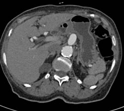 Celiac Artery Aneurysm - CTisus CT Scan