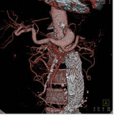 Celiac Artery Aneurysm - CTisus CT Scan