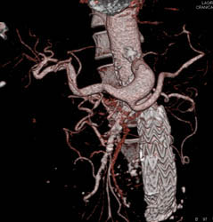 Celiac Artery Aneurysm - CTisus CT Scan