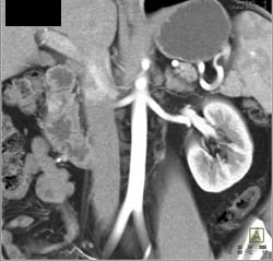 Small Second Artery to Upper Pole of Each Kidney in Renal Donor - CTisus CT Scan