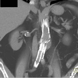 Bilateral Renal Artery Aneurysms - CTisus CT Scan