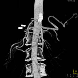 Patent Stent in Celiac Artery With Minimal Plaque - CTisus CT Scan