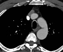 Coarctation of the Aorta - CTisus CT Scan