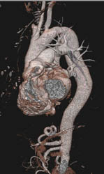 Coarctation of the Aorta - CTisus CT Scan