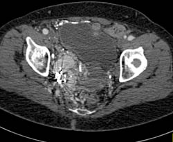 Pelvic Arteriovenous Malformation (AVM) Still Present Despite Embolization - CTisus CT Scan