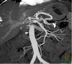 Superior Mesenteric Artery (SMA) Stenosis - CTisus CT Scan