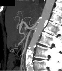 Superior Mesenteric Artery (SMA) Stenosis - CTisus CT Scan