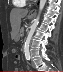 Superior Mesenteric Artery (SMA) Stenosis - CTisus CT Scan