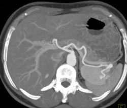 Splenic Artery Aneurysm - CTisus CT Scan