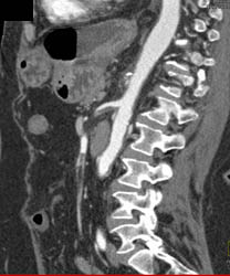 Superior Mesenteric Artery (SMA) Stenosis - CTisus CT Scan