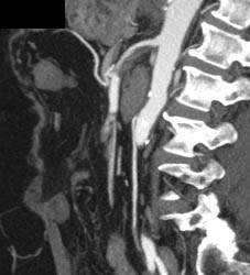 Superior Mesenteric Artery (SMA) Stenosis - CTisus CT Scan