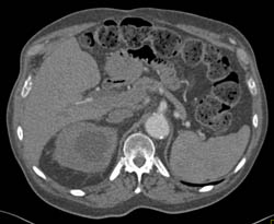 Thrombosed Aortic Leak With Large Mass - CTisus CT Scan