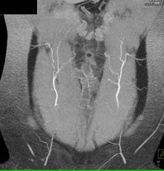 DIEP Planning for Breast Reconstruction - CTisus CT Scan