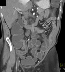 Crohn's Disease - CTisus CT Scan