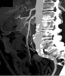 Patent SMA and Celiac Artery With Abdominal Aortic Aneurysm (AAA) - CTisus CT Scan