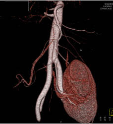 Pelvic Kidney - CTisus CT Scan