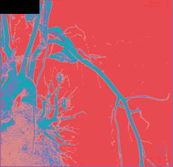 Trauma With Clavicle Fracture Without Vascular Injury - CTisus CT Scan