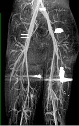 Patent SFA and Popliteal Artery - CTisus CT Scan