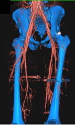 Runoff With Good Mapping - CTisus CT Scan