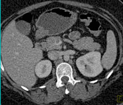 Superior Mesenteric Vein (SMV) Clot Due to Carcinoid Tumor - CTisus CT Scan