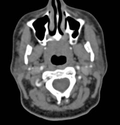 Ectatic Carotid Artery in Loez-dietz Syndrome - CTisus CT Scan