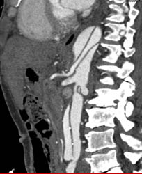 Aortic Dissection Extends Into Celiac and SMA - See Sequence - CTisus CT Scan