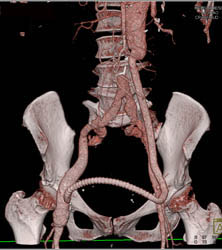 Fem-fem Bypass With Iliac Occlusion - CTisus CT Scan