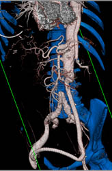 Celiac Aneurysm With Repair - CTisus CT Scan