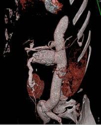 SMA Aneurysm in Loeys-dietz Syndrome - CTisus CT Scan