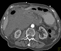 SMA Occlusion With Active Bleed - CTisus CT Scan