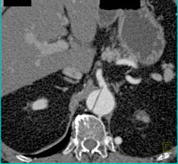 SMA Dissection Arises Off Aortic Dissection - CTisus CT Scan