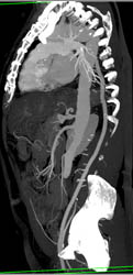 Bypass From Thoracic Aorta to SFA - CTisus CT Scan