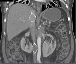 2 IVC Filters - CTisus CT Scan