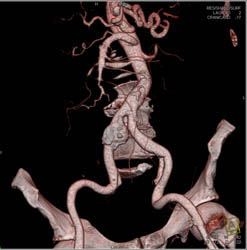 Iliac Aneurysm With Focal Dissection - CTisus CT Scan