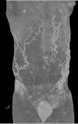 Huge Collaterals in Abdominal Wall Due to IVC Collateral Pathways- See Full Sequence - CTisus CT Scan