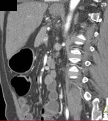 Acute Thrombus in SMA - CTisus CT Scan