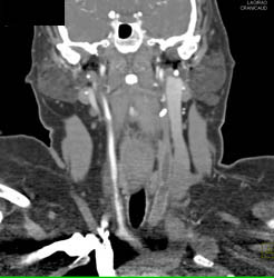 Occluded Proximal Left Carotid Artery - CTisus CT Scan