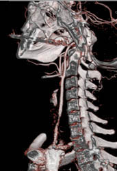 Carotid Stenosis - CTisus CT Scan