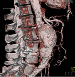 Abdominal Aortic Aneurysm (AAA) Is Bilobed - CTisus CT Scan