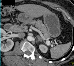 Splenic Artery Aneurysm Simulates A Pancreatic Mass - CTisus CT Scan