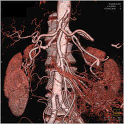 Fibromuscular Dysplasia (FMD) Right Renal Artery- Incidental - CTisus CT Scan