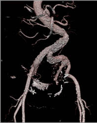Extensive Plaque Aorta and Iliac Artery - CTisus CT Scan