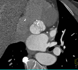 Bicuspid Valve With Calcification and Dilated Ascending Aorta as Well as Prior Coarctation of the Aorta (COA) Repair - CTisus CT Scan