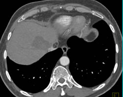 Pseudo clot Inferior Vena Cava (IVC) - CTisus CT Scan