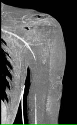 Axillary Artery Injury - CTisus CT Scan