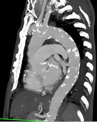 Calcified Plaque Descending Aorta - CTisus CT Scan