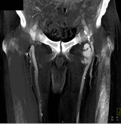 Pseudoaneurysm Left Groin Off SFA - CTisus CT Scan