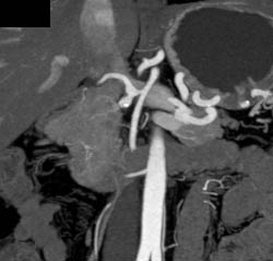 Gastroduodenal Artery (GDA) Aneurysm - CTisus CT Scan