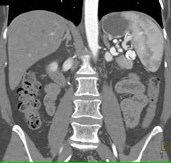 Splenic Artery Aneurysm - CTisus CT Scan