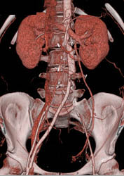 Occluded Left Common Iliac Artery and Collaterals - CTisus CT Scan